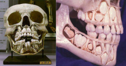syldoran:  medicalschool:  A child’s skull prior to loosing
