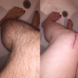 hirsutism-portraits:  I made the decision to shave some of my