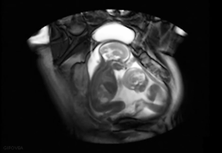 sixpenceee:  Twins interact with each other in the womb The University