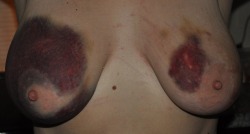 otherrealm:  We both loved the tit bruising, the one on the left