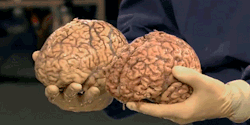 milesian:  A healthy human brain (left) compared to the brain