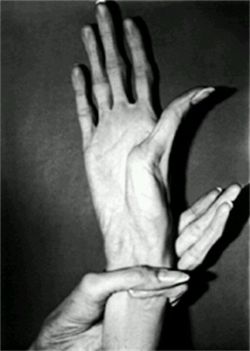 sixpenceee:  Marfan syndrome is a disorder of connective tissue, the tissue that strengthens the body’s structures. Disorders of connective tissue affect the skeletal system, cardiovascular system, eyes, and skin.