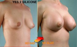 faketitslover999:   boobinfo:  YES 2 SILICONE. SCIENCE!  Silikon macht Frauen schöner!   Natural or nah?