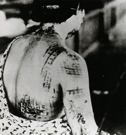 A Japanese woman awaits treatment, her back scarred by the patten of the dress she was wearing when the world’s first atomic bomb used in warfare fell on Hiroshima on August 6, 1945. Since white colors repelled the bomb’s heat and dark colors absorbed
