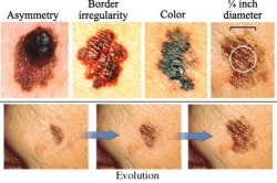 fostresszshalm:Do You Have Skin Cancer?# 5 Learn Your ABCDE’sLook at your moles and imagine that there is an imaginary line drawn down the middle. If the mole is asymmetrical, or uneven, on either side then this is one of the warning signs you should