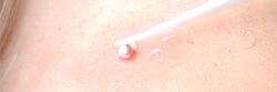 Learn   Skin Tag Removal at Home at:http://www.cliffys.com.au/removal-guide/in-home-skin-tag-removal/