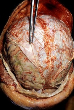 Just beneath the skull is a tough, leathery layer called the dura mater.