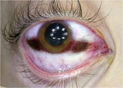 Postmortem corneal clouding with tache noire. If the eyes remain open after death, the areas of the sclera exposed to the air dry out, which results in a first yellowish, then brownish-blackish band like discoloration zone called tache noire. It is most