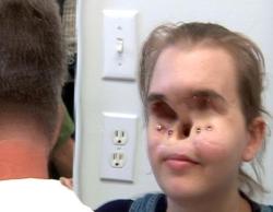 congenitaldisease:  Chrissy Steltz of Oregon was just 16-years-old when she was shot in the face with a shotgun. The blast destroyed her eyes and her nose.  Eleven years later surgeons created a prosthetic face to cover her injuries.
