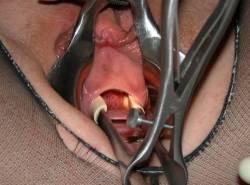 pussymodsgaloreA vaginal speculum holds her pussy open, and then what looks like a nasal speculum is used to stretch her peehole and urethra open. Well lit so that we can see inside.