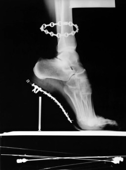 Helmut Newton - X-Ray of High Heeled Shoe and Cartier Bracelet, Paris, 1994.