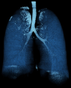 medicalschool:  Lungs Volume Rendering of an ECG gated I.V. contrast enhanced thoracic CT angiography. Pictured above is the lung. The lung shows several small emphysematous bullae.