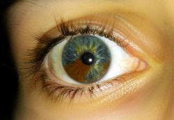  In sectoral heterochromia one part of the eye is different from it’s remainder. Heterochromia, in general is the result of excessive pigment. It can be inherited or caused by disease &amp; injury.  