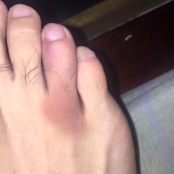 Busted my toe two days ago at 3am walking back from the bathroom #ouch