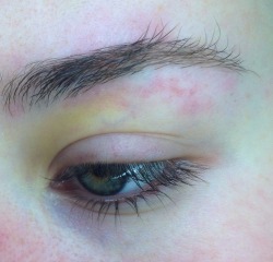  beautiful remnants of a painful black eye 