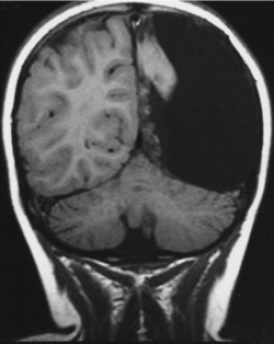 strangebiology:  A three-year-old girl had a hemispherectomy to treat Rasmussen syndrome. This MRI scan was taken in 2002 after she had turned seven. The right hemisphere of her brain, which was completely removed, contained the language center and motor