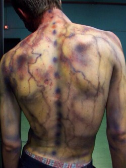 fierocity:  imyobabyy:  lady-medic:  In case anyone wanted to know what a lightening strike can do to the body- given that they survive.  Woah  I’ve reblogged this before but I didn’t know it was from a lightning strike. That’s insane.        