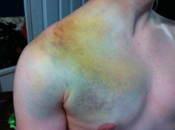 bowlofbloodoranges:  squirtol:  lessons-in-gore:  Bruise from a snowboarding accident that involved a collarbone broken in two places and a dislocated shoulder.  I realize that this is like from him being hurt….but it kinda hot… Lol  bruises are just