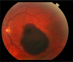 neurosciencestuff:  Research Points to Promising Treatment for Macular Degeneration Experiments show promising results for a drug that could lead to a lasting treatment for millions of Americans with macular degeneration. Researchers at the University