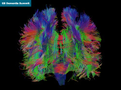 bpod-mrc:  11 December 2013 Ageing Brains A normal healthy brain (pictured is a map showing connections in an older brain) is something most of us take for granted. However, more people over the age of 65 are disabled by dementia than any other illness.