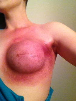 nerdy-king-of-hell:  mybigfatfitlife: joggingthedollytrack:  swallowthatshit:  pushinginthepin:  pushinginthepin:  Here’s your fucking breast cancer awareness.   This was during my 35 day radiation treatment back in 2013. Breast cancer isn’t sexy.