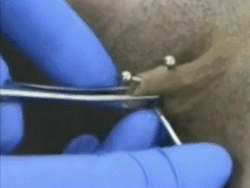 pussymodsgaloreShe already has a VCH piercing with a curved barbell, now a piercing needle is pushed through underneath her clit , to be followed by a ring, for a triangle piercing. (Not to be confused with the much more common and shallower HCH which