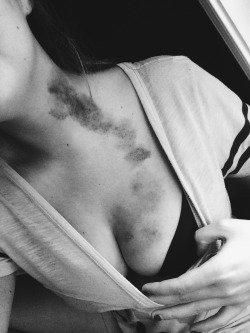 hahacunt:  Hickeys are cool