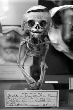 deformed child skeleton
