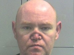 Collapsed nose resulting from cocaine addiction