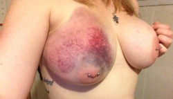 sydney-sadist:  The bigger the tit, the bigger the bruise. 