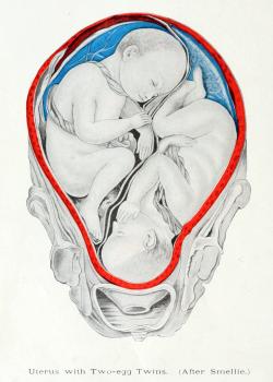 biomedicalephemera:  Types of Twins Twins are more complex than just “identical” and “fraternal”! Fraternal (or Sororal) Twins When two eggs are released by the mother, and both are fertilized and implant successfully, two completely different
