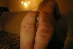 hipposloveme:My ass from last night, mm the bruises. Ass hurts now :( 