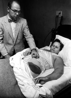 corporisfabrica:  1954: the giant bruise
