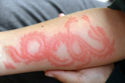coltre:  Painful allergic reaction to henna, in the exact shape of the tattoo. 