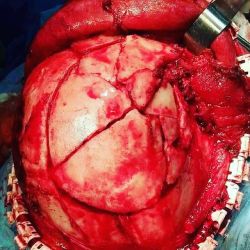 doctordconline:Compound Depressed Skull Fracture ….  #RTA #fracture #skull #neurosurgery #emergency #surgery #usmle #pathology #usmlestep1 #usmlestep2 #neurosurgeon #doctor #doctordconline #nhs #nurse #nursing #hospital #patient #mbbs #md @doctordconline
