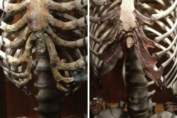 spoookyscary:  From the MutterMuseum - the deformed ribcage of a woman who wore corsets vs a normal ribcage 