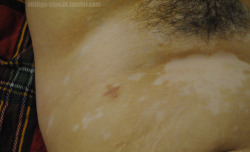 vitiligo-clouds:miss me?