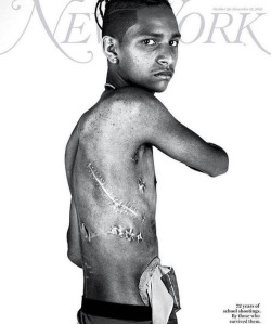 vagabondretired: Get the point?On the cover is 15 year old Parkland student Anthony Borges who was shot five times Feb. 14 during the school massacre. The photo features him shirtless with his surgical scars exposed while wearing a colostomy bag. This