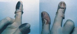 The fingerprinting of a decomposed corpse sometimes requires the medical examiner to remove the deceased’s fingertips and slip them over their own gloved fingertips, which then allows them to take the prints.
