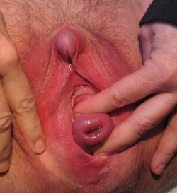 biggergapes-betterbabes:  descensus uteri, prolapsus uteri  Wow! Amazing clit, amazing cervix prolapse. Very unique cunt. Lots to play with there.