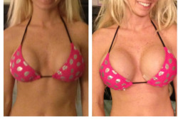 Proof of the boobie greed syndrome. This hot babe is still in surgical tape, but had to show off her new upgrade in the same bikini.Nice Job Baby!!