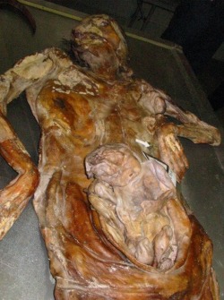 Remains of a pregnant Bosniak (Bosnian Muslim) woman and her unborn baby excavated from the mass grave Suha in Srebrenica region, near Bratunac. Baby&rsquo;s undeveloped head, fingers, and legs are clearly visible. The massacre was committed by Serbs