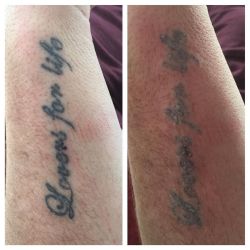 Tattoo Laser Removal done today! Get booked in for yours now! Appointments left today tomorrow and Monday! Get in touch for bookings! #tattooremoval #carbonlaserfacial #tattoo #kettering #Northamptonshire #essex by charleyatwell