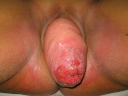 cafenastycore:  ill pound that vaginal prolapse cervix hole any day  100% total prolapse (medical photo). Could always just shove it back in and then plug her pussy with a very large pussy plug and some rubber panties to keep it in. Problem solved!