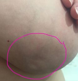 rosezeee:  micdotcom:  Don’t scroll past this. Kylie Armstrong was diagnosed with breast cancer and these small dimples were the only signs. She posted the image on Facebook so everyone knows that “that breast cancer is not always a detectable