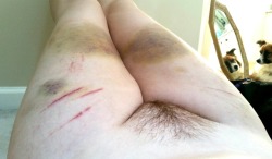 princesssparklecunt:  The bruises are pretty