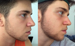 robichau-x:-beard update-So i have a really big interview tomorrow, so say goodbye to the beard! It was fun while it lasted. I just wanna look professional ya know? Heres a comparasion of 4 days no shave to 2 weeks no shave. gotta admit i was starting
