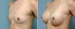 20aliens:  breast augmentation