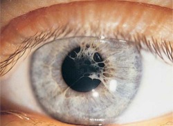 Sixpenceee:  Persistent Pupillary Membranes Are Strands Of Tissue In The Eye. They