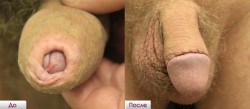 male-tamer-059:  circumcisedperfection:  pasantlyqualitymaker:  Circumcision promotion in Russia  What an incredible improvement   Such a snug, low cut!! And you can just see how rough and dried that glans is; I can’t guess how desensitized it is becoming